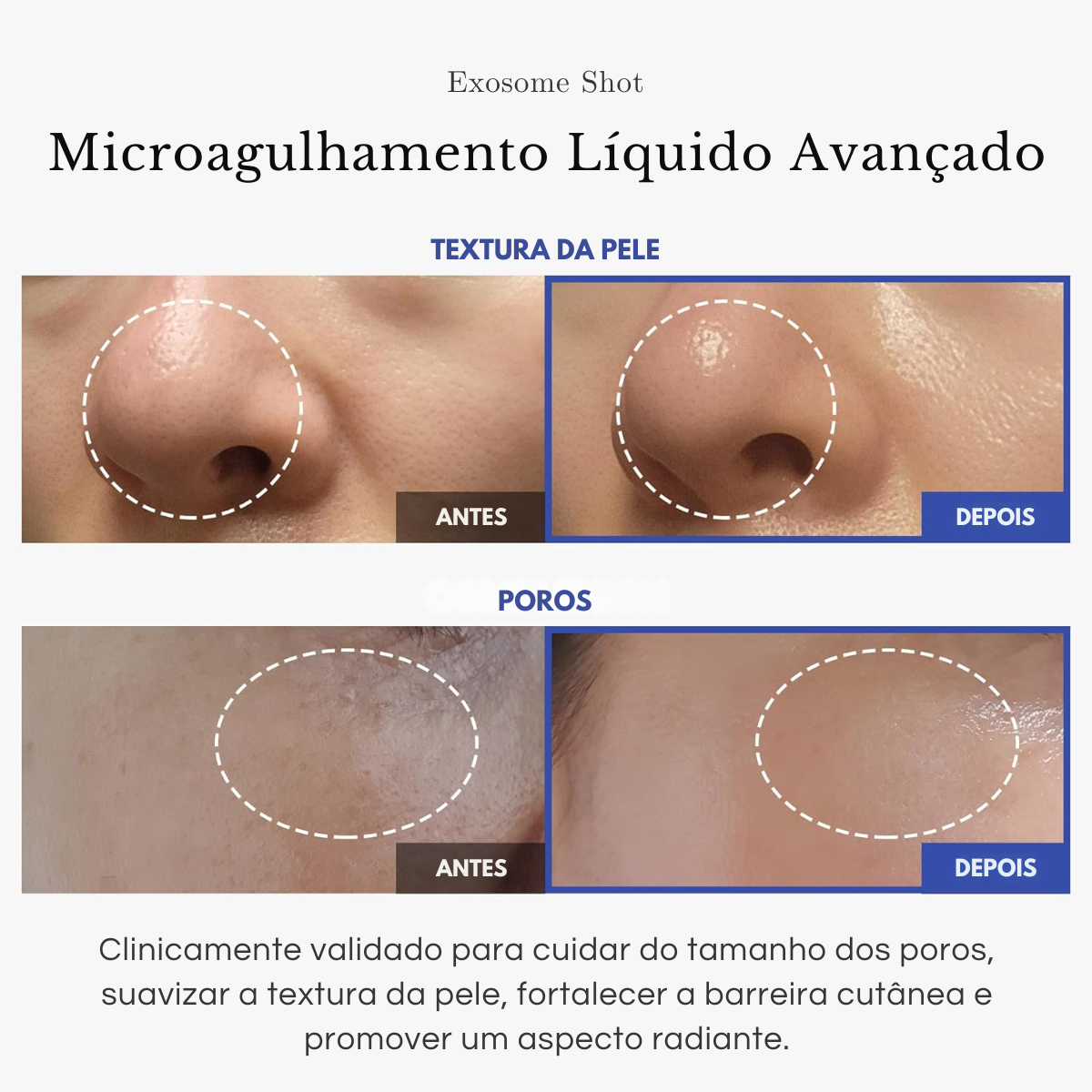 EXOSOMEN HEIß * flüssiges Microneedling